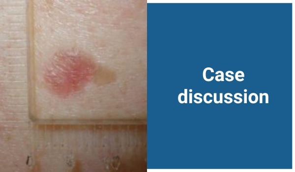 case discussion
