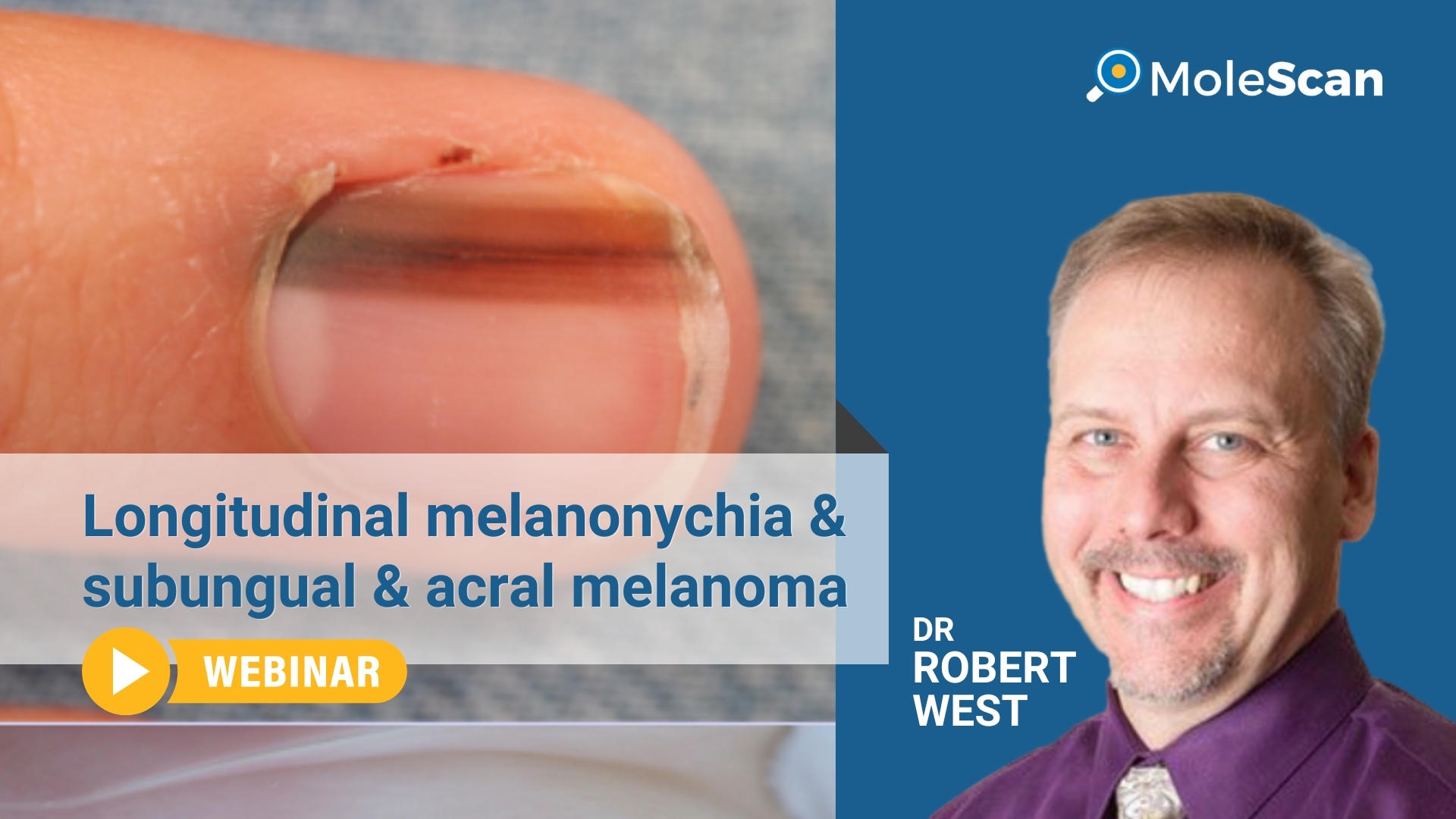 subungual and acral melanoma