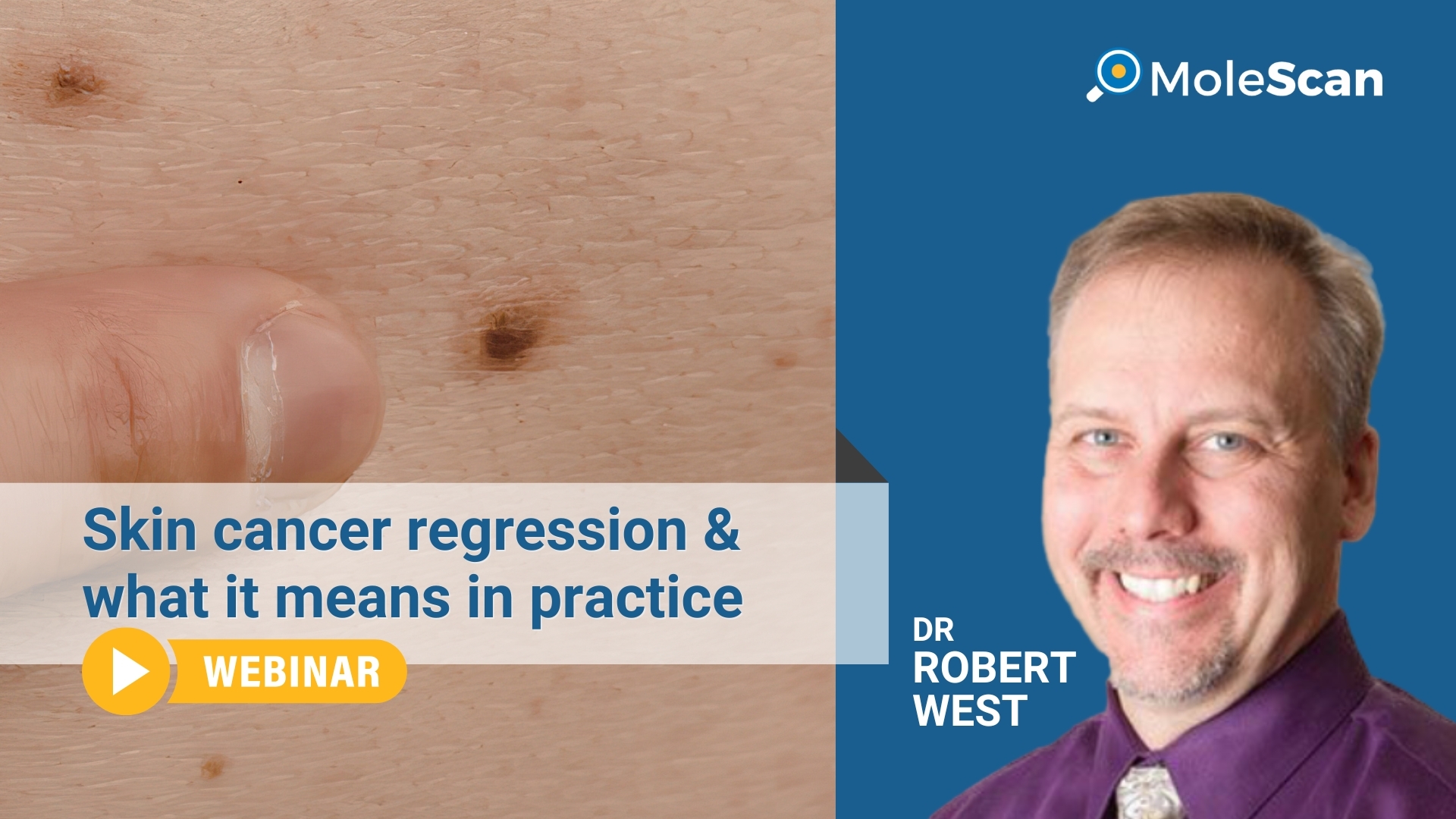 skin cancer regression